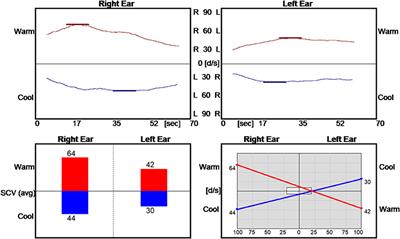 Case Report: Bow Hunter Syndrome—One Reason to Add Non-gravity Dependent Positional Nystagmus Testing to Your Clinical Neuro-Otologic Exam